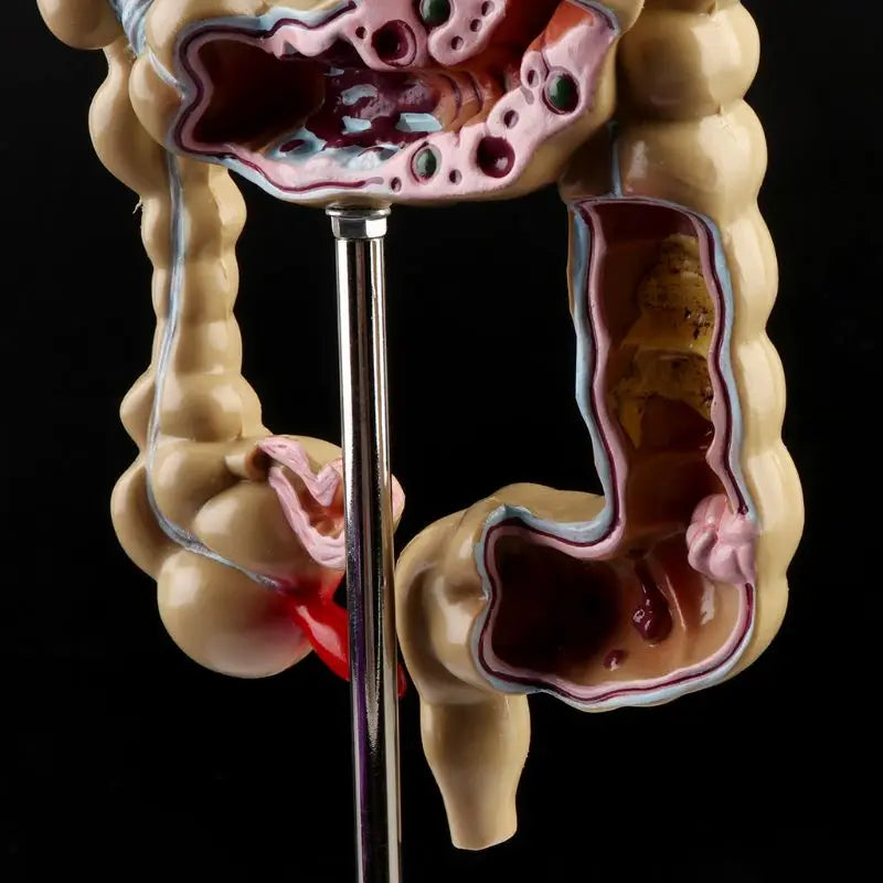 Model Patologic Colon și Rect