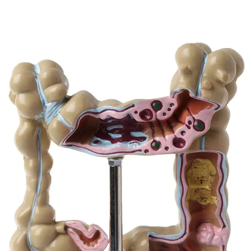 Model Patologic Colon și Rect